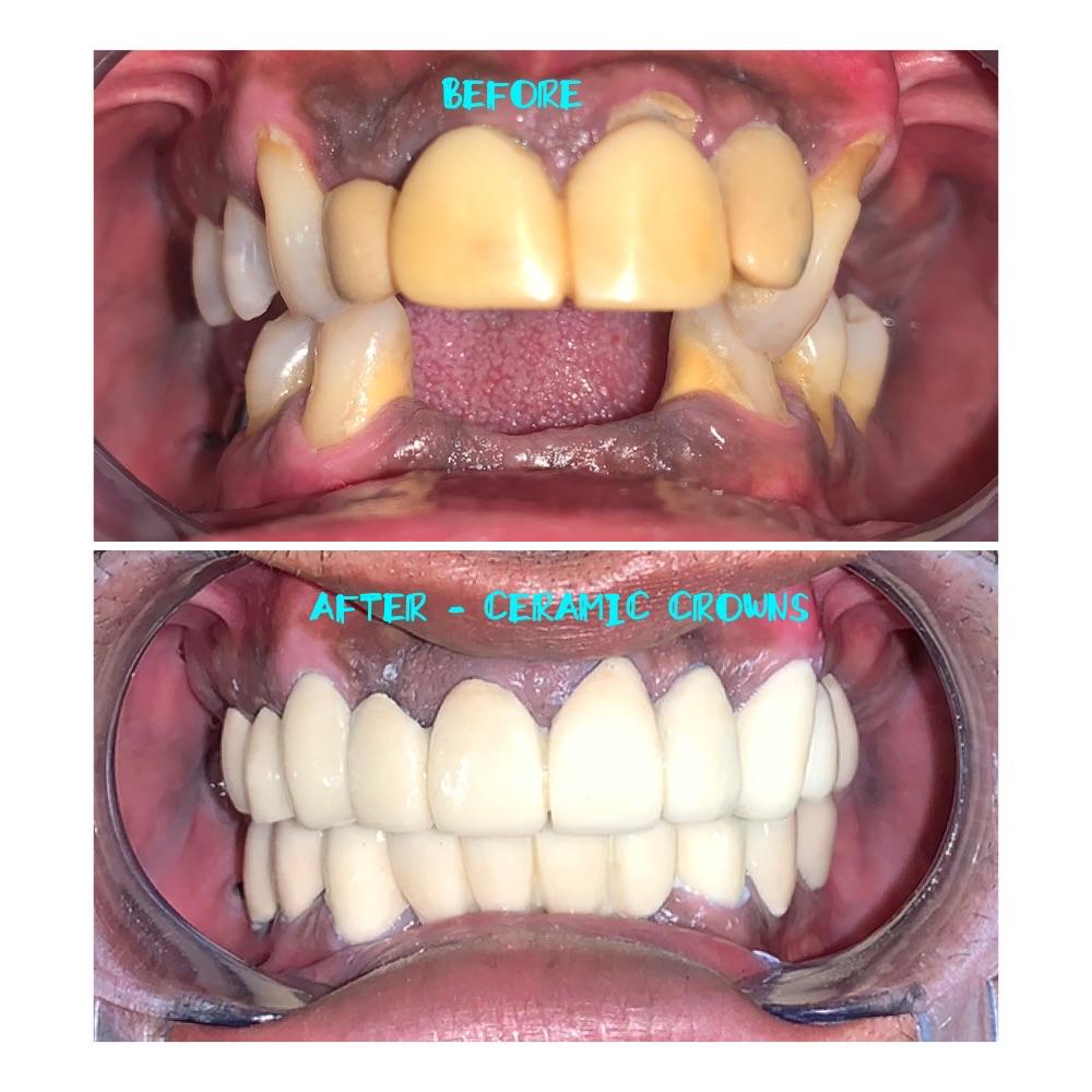 Ceramic crowns before and after