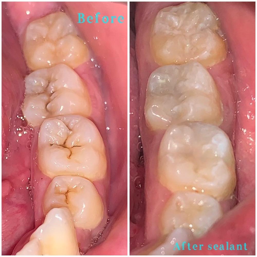 Dental sealant before and after