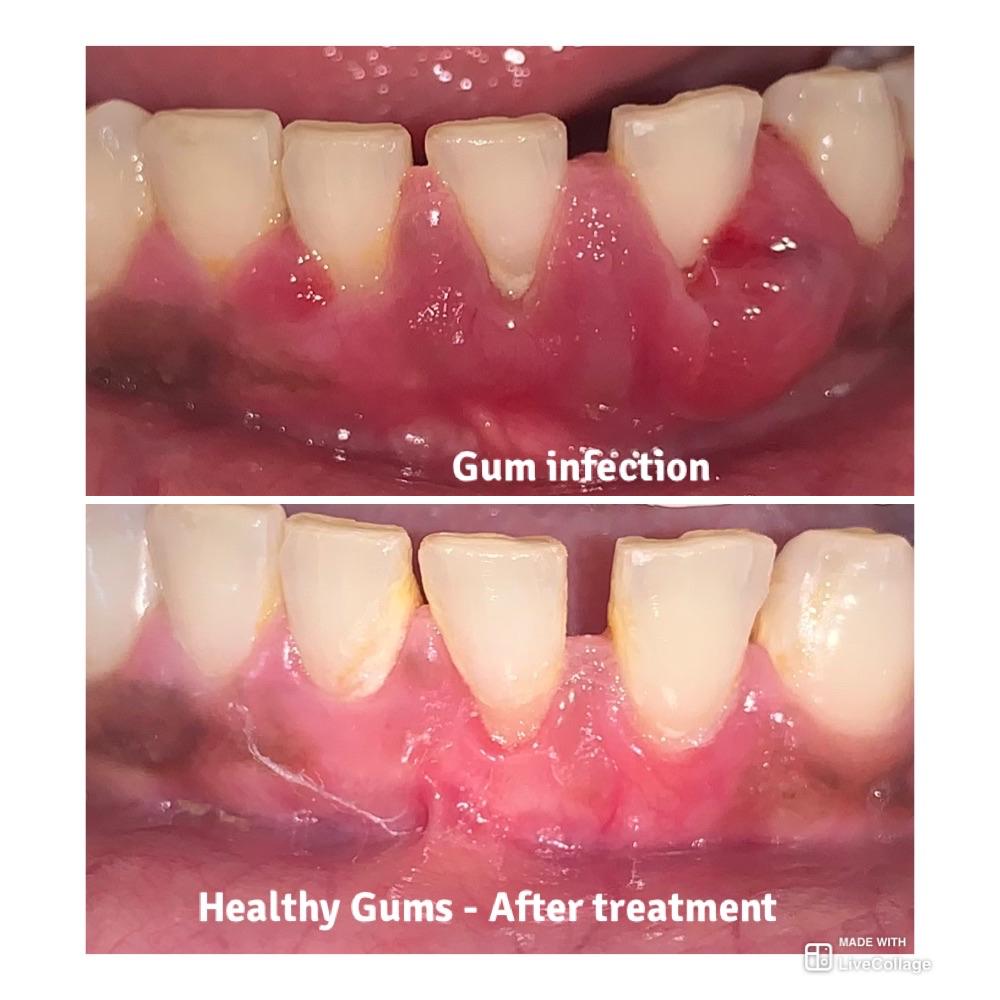 Gum infection treatment