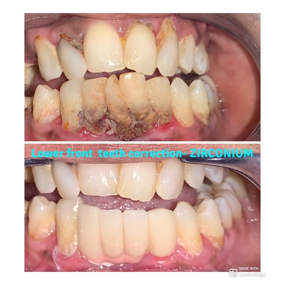 Lower front teeth correction with zirconium