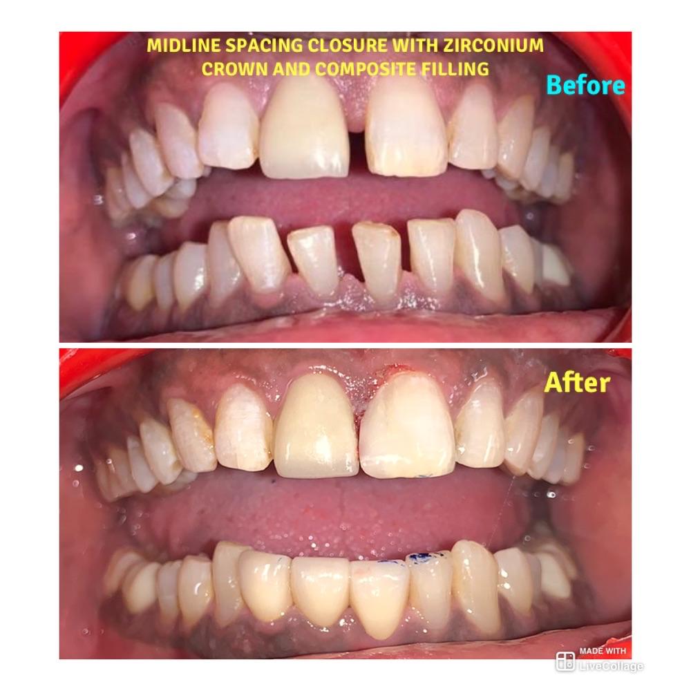 Midline spacing closure with zirconium and composite