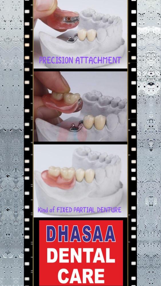 Precision attachment fixed partial denture