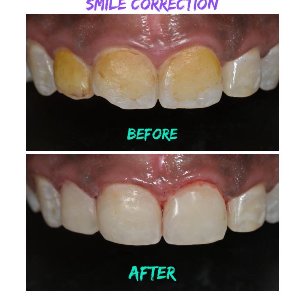 Smile correction before and after