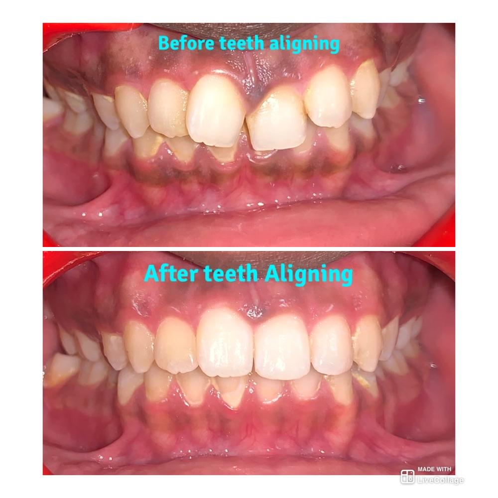 Teeth aligning before and after