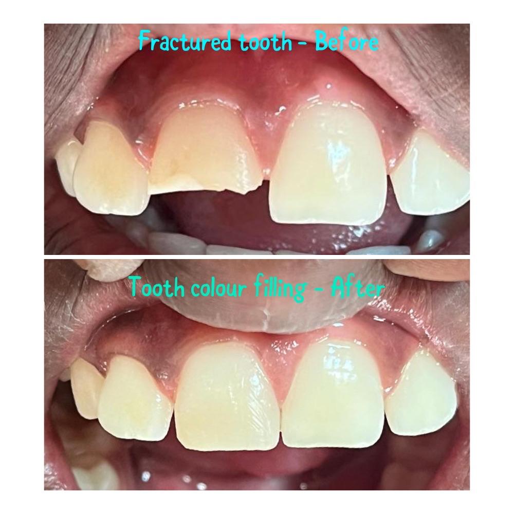 Tooth colour filling for fractured tooth