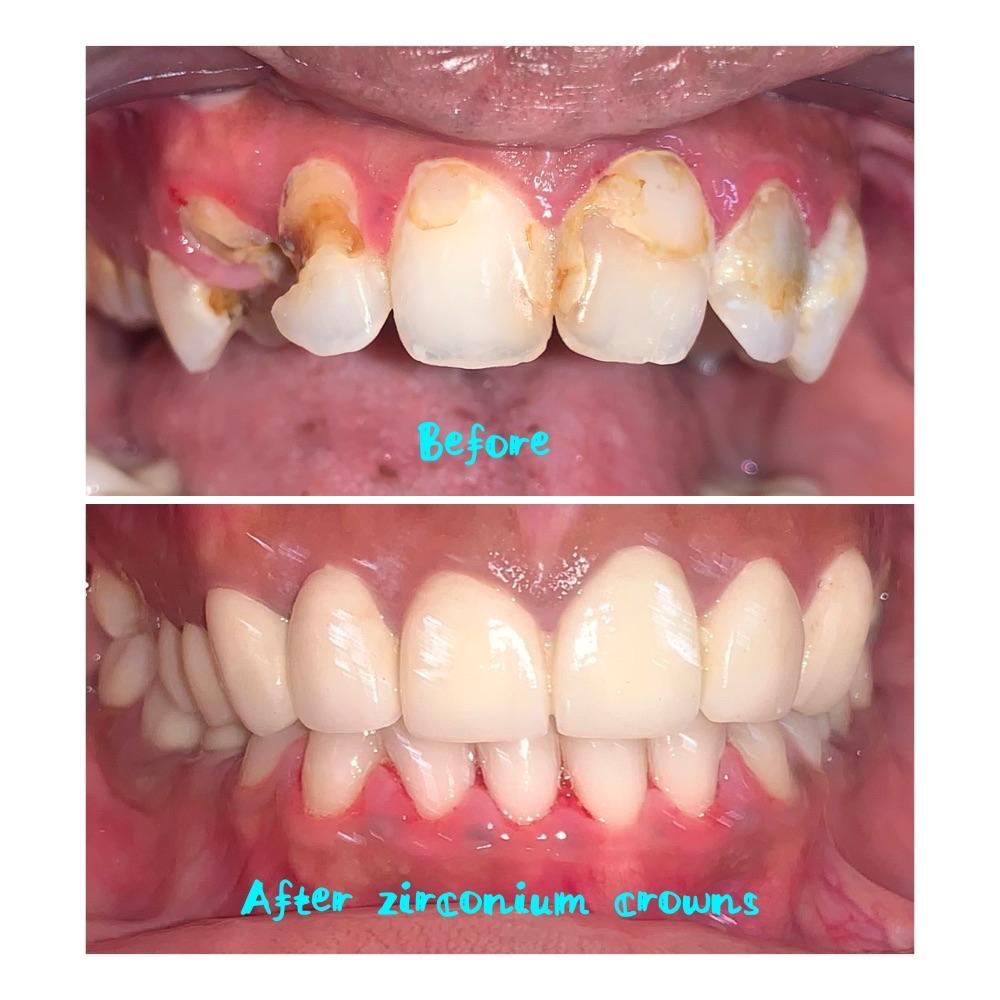 Zirconium crowns before and after